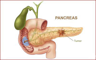 سرطان پانکراس