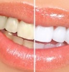 روشهای خانگی سفیدکردن دندان